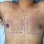 Liposuction Before & After Patient #841