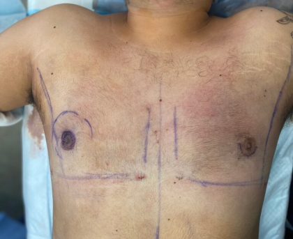 Liposuction Before & After Patient #841