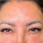 Botox Before & After Patient #534