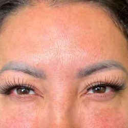 Botox Before & After Patient #534