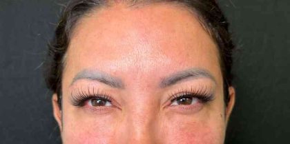 Botox Before & After Patient #534