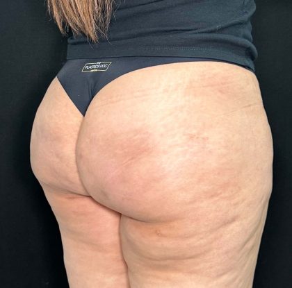 Aveli Before & After Patient #510