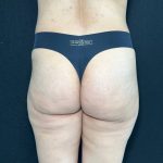 Aveli Before & After Patient #531