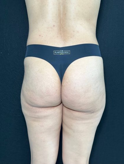 Aveli Before & After Patient #531