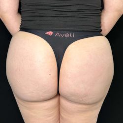 Aveli Before & After Patient #528