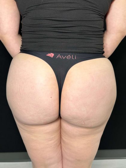 Aveli Before & After Patient #528