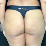 Aveli Before & After Patient #513