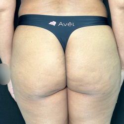 Aveli Before & After Patient #513