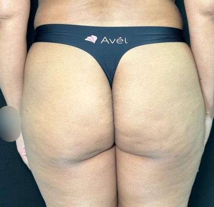 Aveli Before & After Patient #513