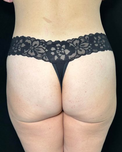 Aveli Before & After Patient #522