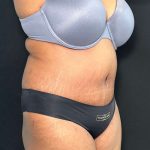 Tummy Tuck Before & After Patient #891