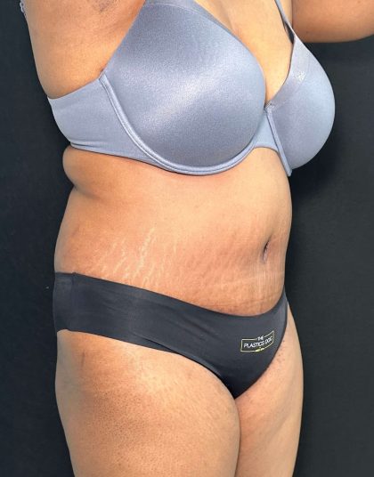 Tummy Tuck Before & After Patient #891