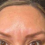 Botox Before & After Patient #537