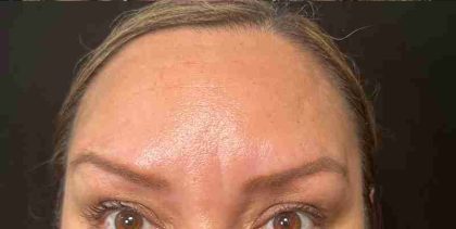 Botox Before & After Patient #537