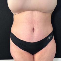Tummy Tuck Before & After Patient #899
