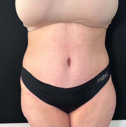 Tummy Tuck Before & After Patient #899