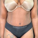 Tummy Tuck Before & After Patient #915