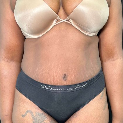 Tummy Tuck Before & After Patient #915