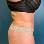 Tummy Tuck Before & After Patient #923