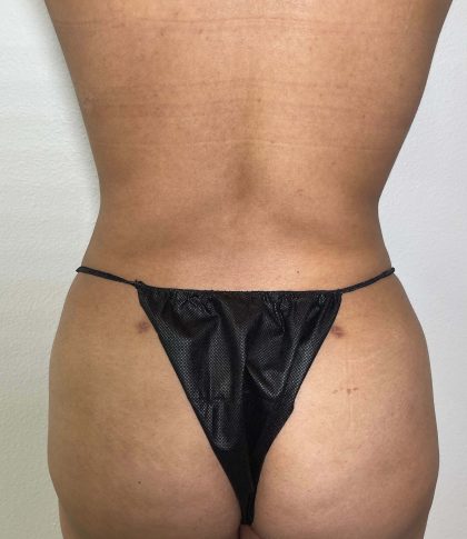 Liposuction Before & After Patient #858