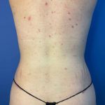 Tummy Tuck Before & After Patient #928