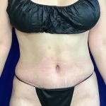 Tummy Tuck Before & After Patient #931