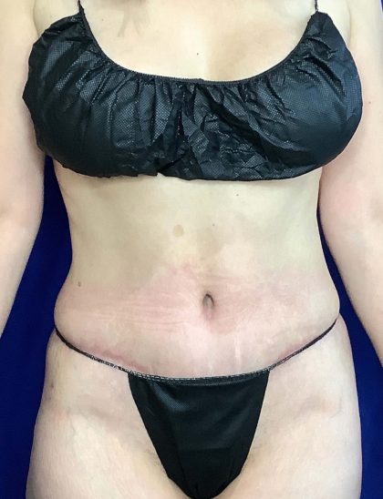 Tummy Tuck Before & After Patient #931