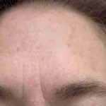 Botox Before & After Patient #540
