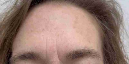 Botox Before & After Patient #540