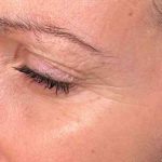 Botox Before & After Patient #543