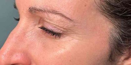 Botox Before & After Patient #543