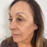 Botox Before & After Patient #552