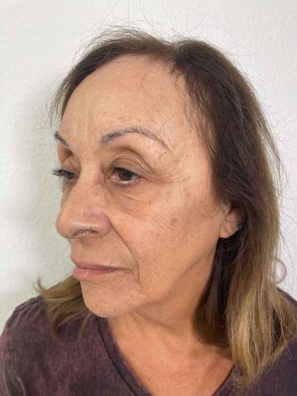 Botox Before & After Patient #552