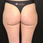 Aveli Before & After Patient #507
