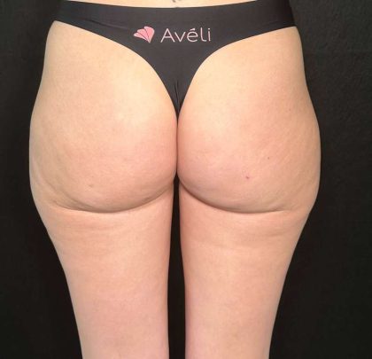 Aveli Before & After Patient #507
