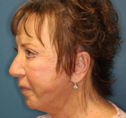 Facelift Before & After Patient #596