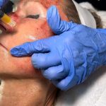 Esthetician Services Before & After Patient #599