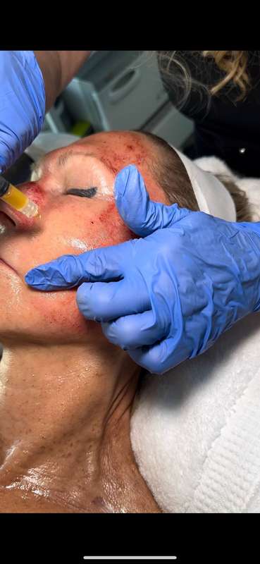 Esthetician Services Before & After Patient #599