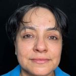 Eyelid Lift Before & After Patient #608