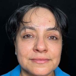 Eyelid Lift Before & After Patient #608