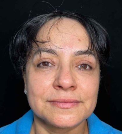 Eyelid Lift Before & After Patient #608