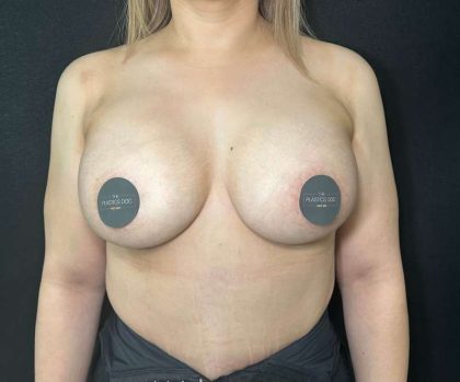 Breast Augmentation Before & After Patient #659