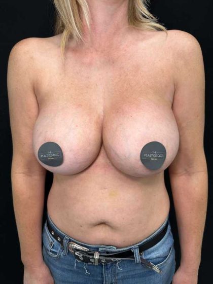 Breast Augmentation Before & After Patient #671