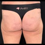 Aveli Before & After Patient #516