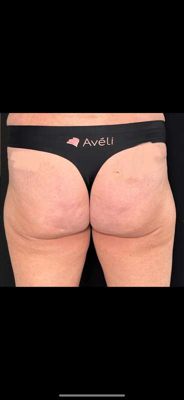 Aveli Before & After Patient #516