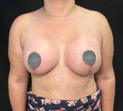 Breast Lift Before & After Patient #733