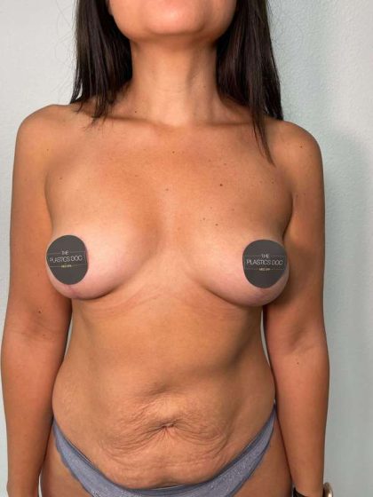 Breast Lift Before & After Patient #745