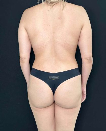 Liposuction Before & After Patient #764