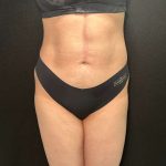 Liposuction Before & After Patient #770