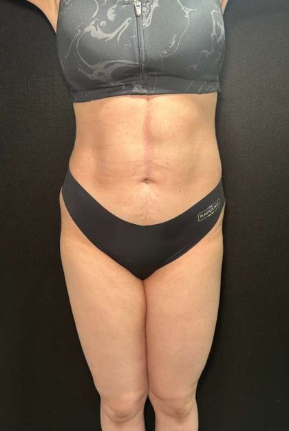 Liposuction Before & After Patient #770